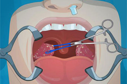 �����廯ŧ��ô�� �����廯ŧҪע��ʲô